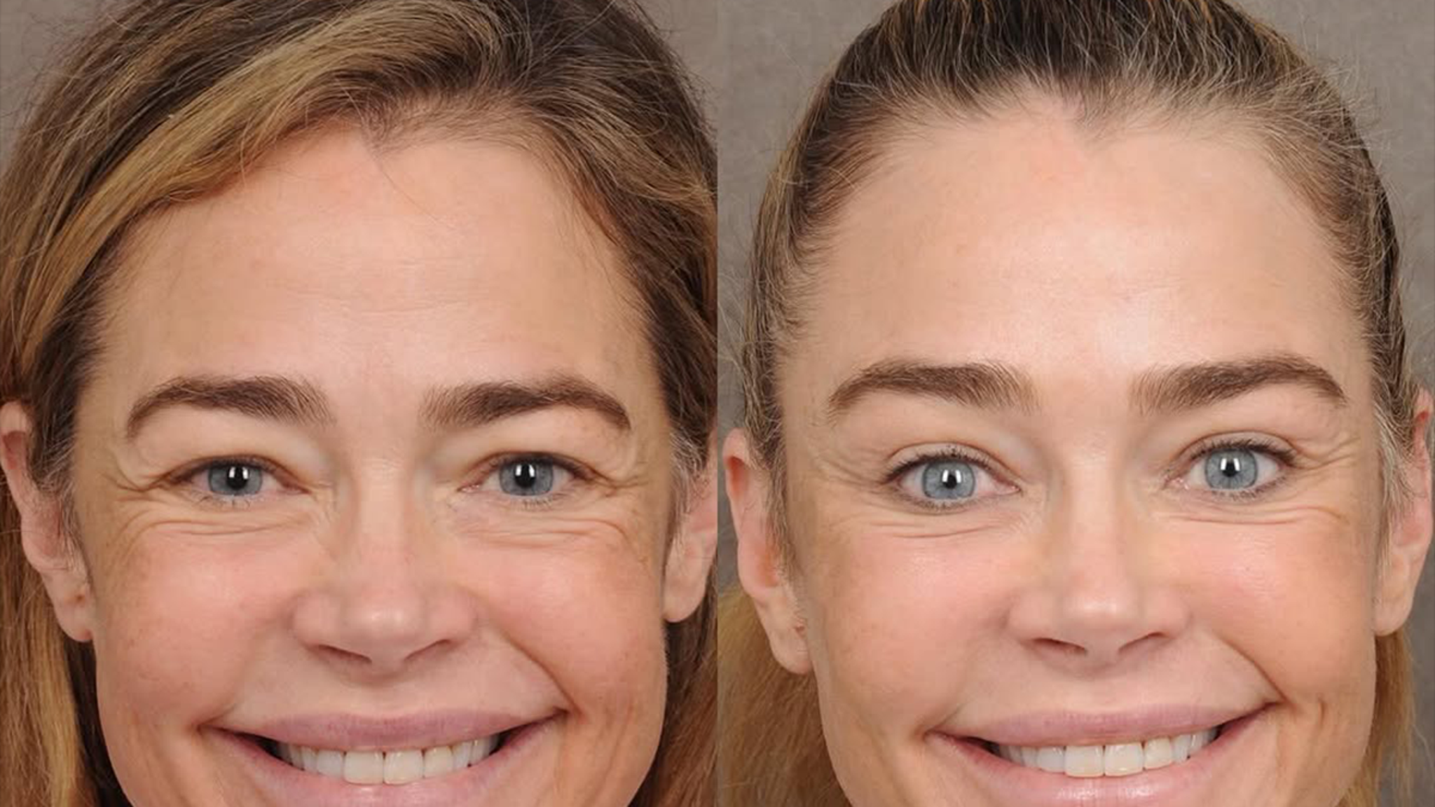 Denise Richards' Doctor Shares Photos Before and After Facelift