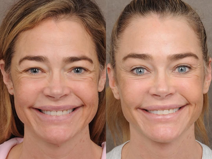 Denise Richards' Facelift