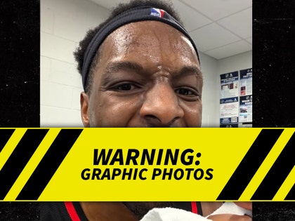 Onyeka-Okongwu-Mouth-Injury-graphic-warning-01