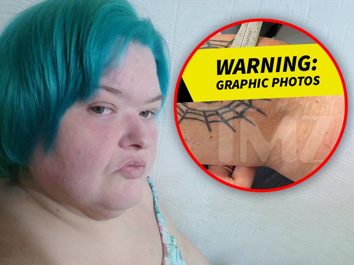 First Look at ‘1000-Lb. Sisters’ Star Amy Slaton’s Wound From ‘Camel Bite’