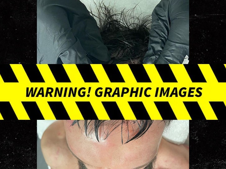 Finn Bálor's Head Injury -- Graphic Photos
