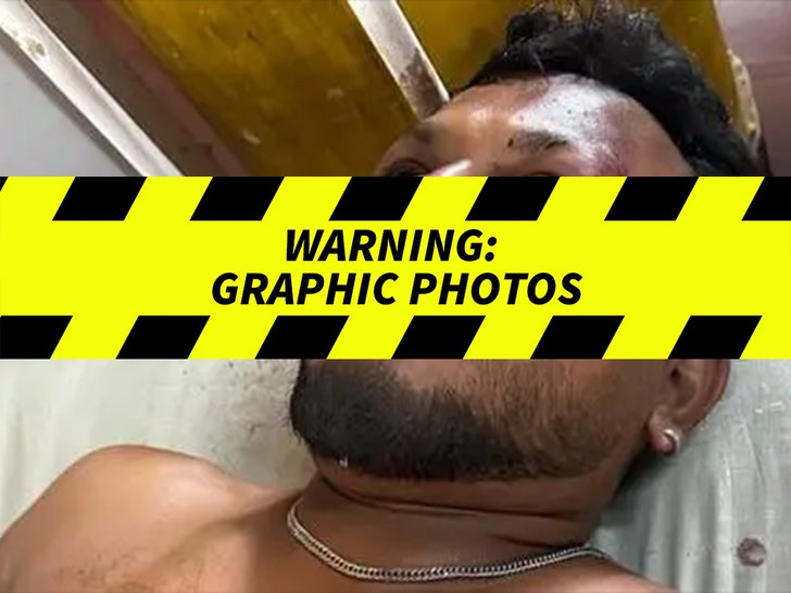 British Survivor From Air India Plane Crash -- Graphic Injuries