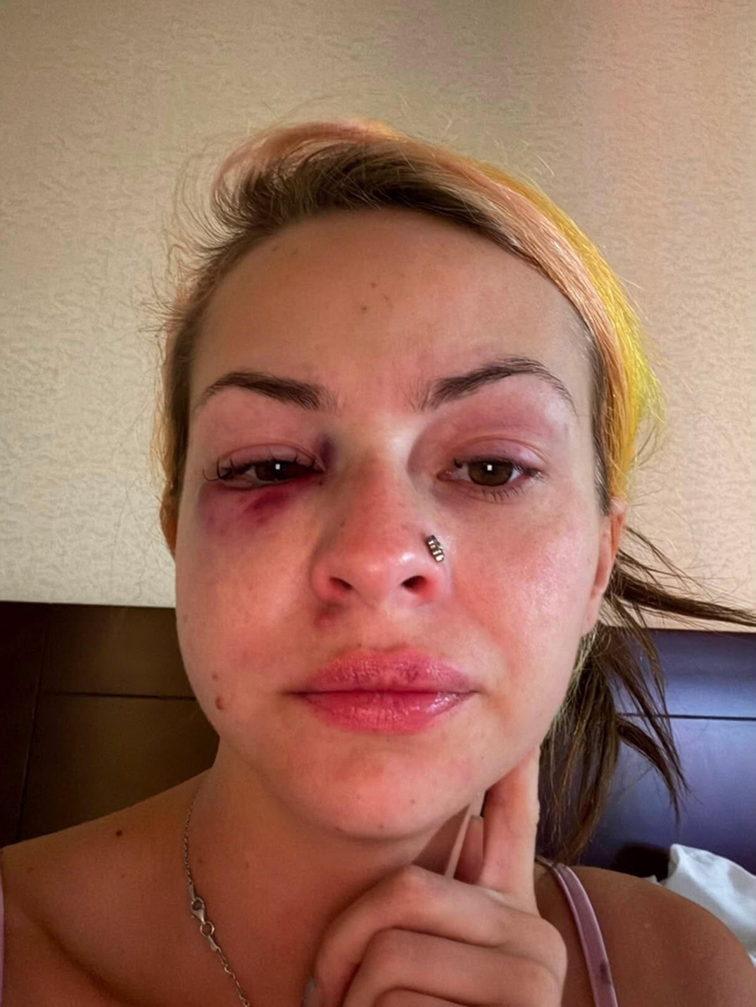 Pam Rodriguez Alleged Injury Photos 2