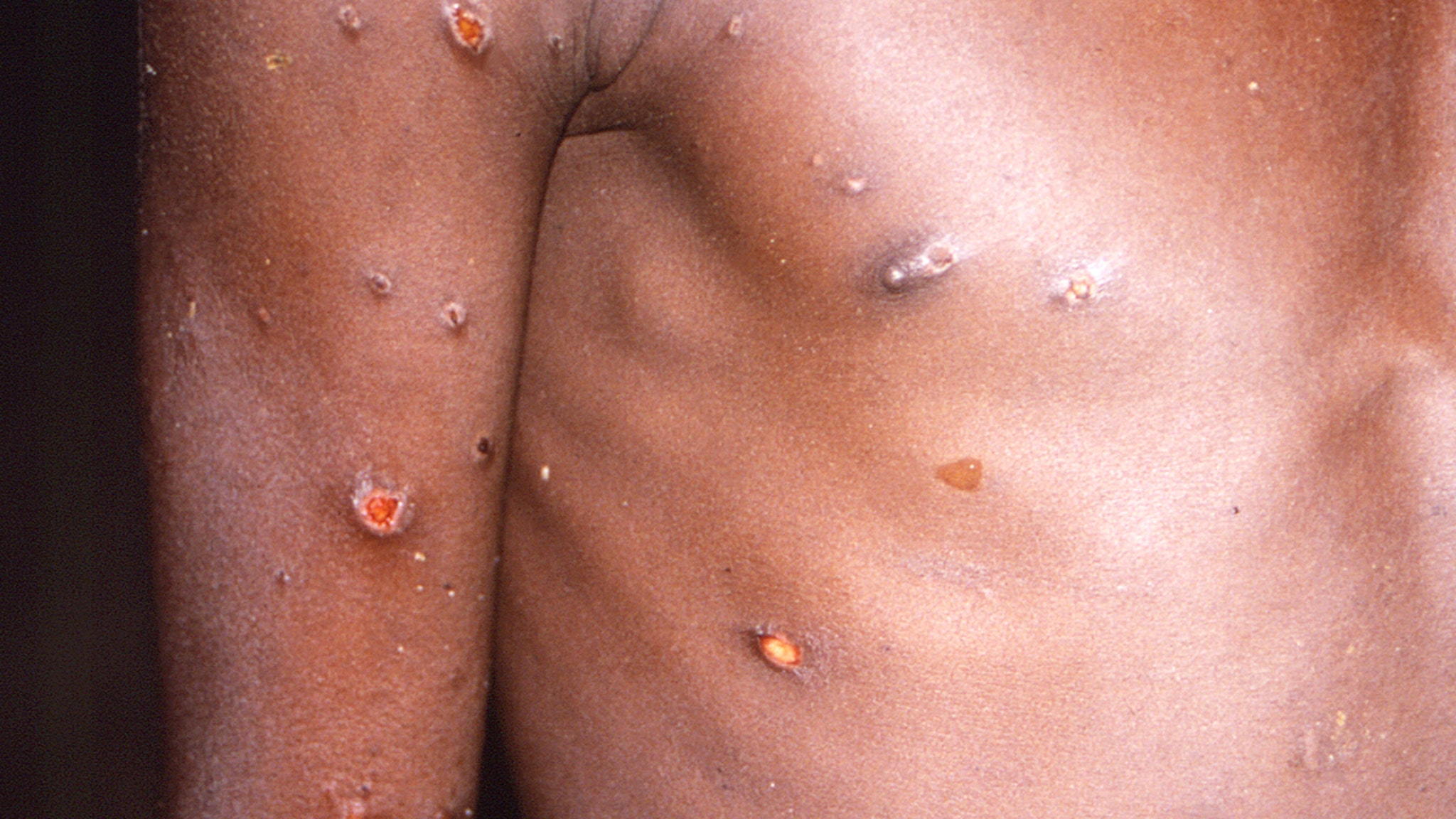 Monkeypox, First Possible Human-to-Human Transmission Spotted in U.S.
