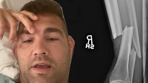 UFC's Chris Weidman Shows X-Rays Of Cracked Leg and It's Nasty