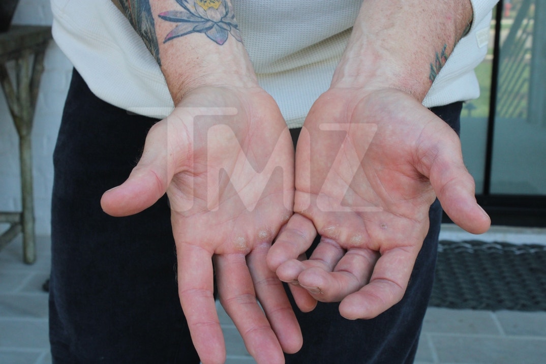 Alan Ritchson Injury Photos 2