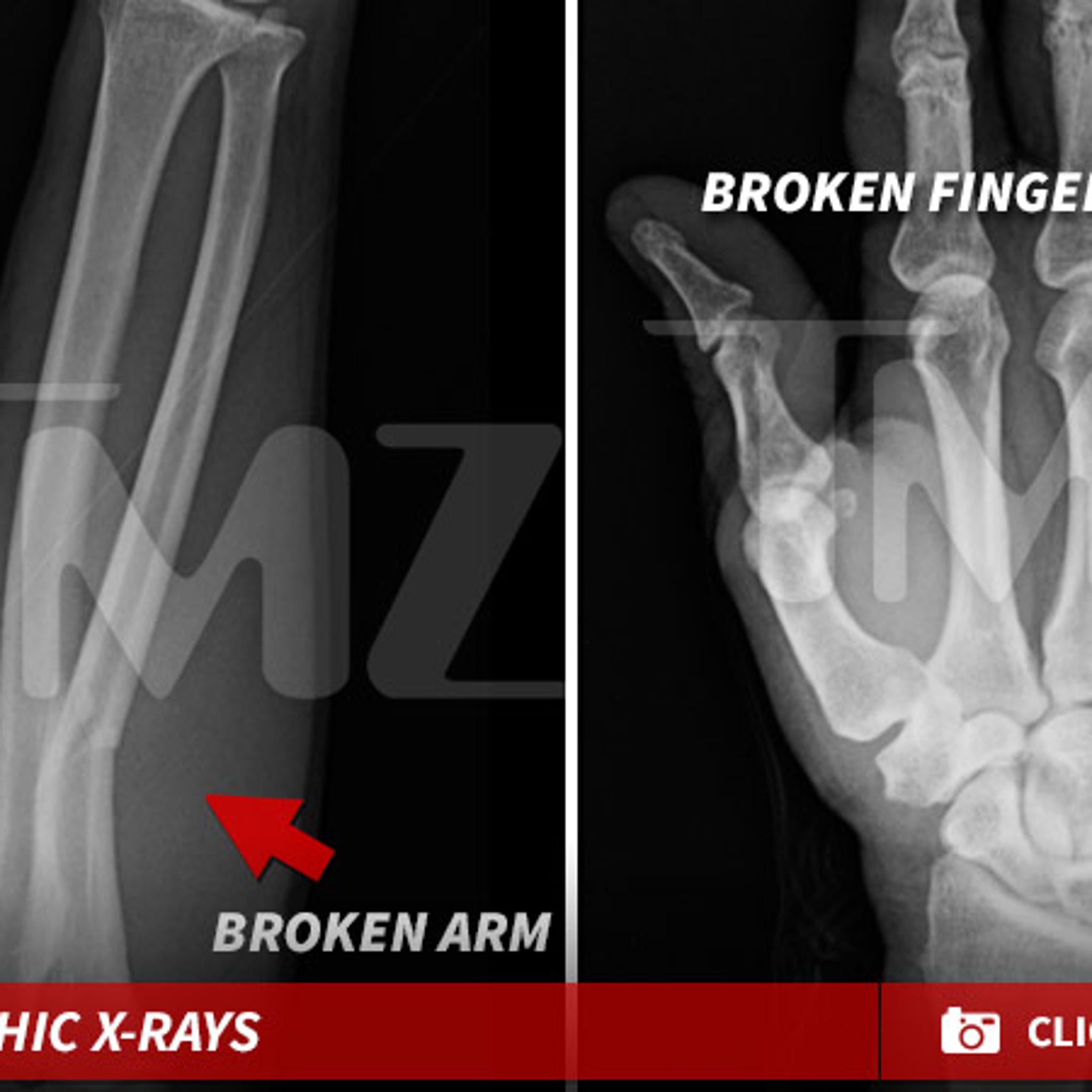 broken hand bones xray