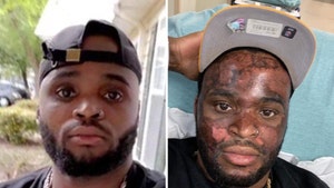 TikTok Chemical Peel Burn Man Awarded $1 Million In Damages for Burnt Face