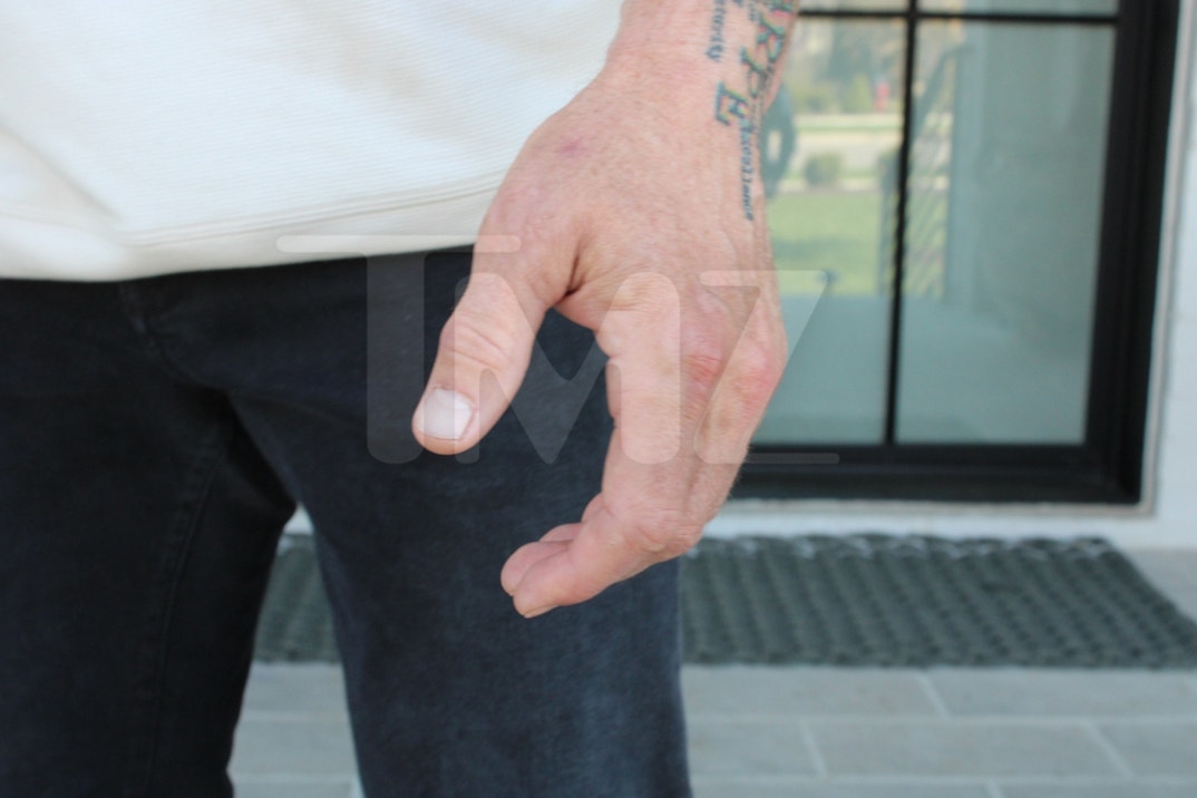 Alan Ritchson Injury Photos 5