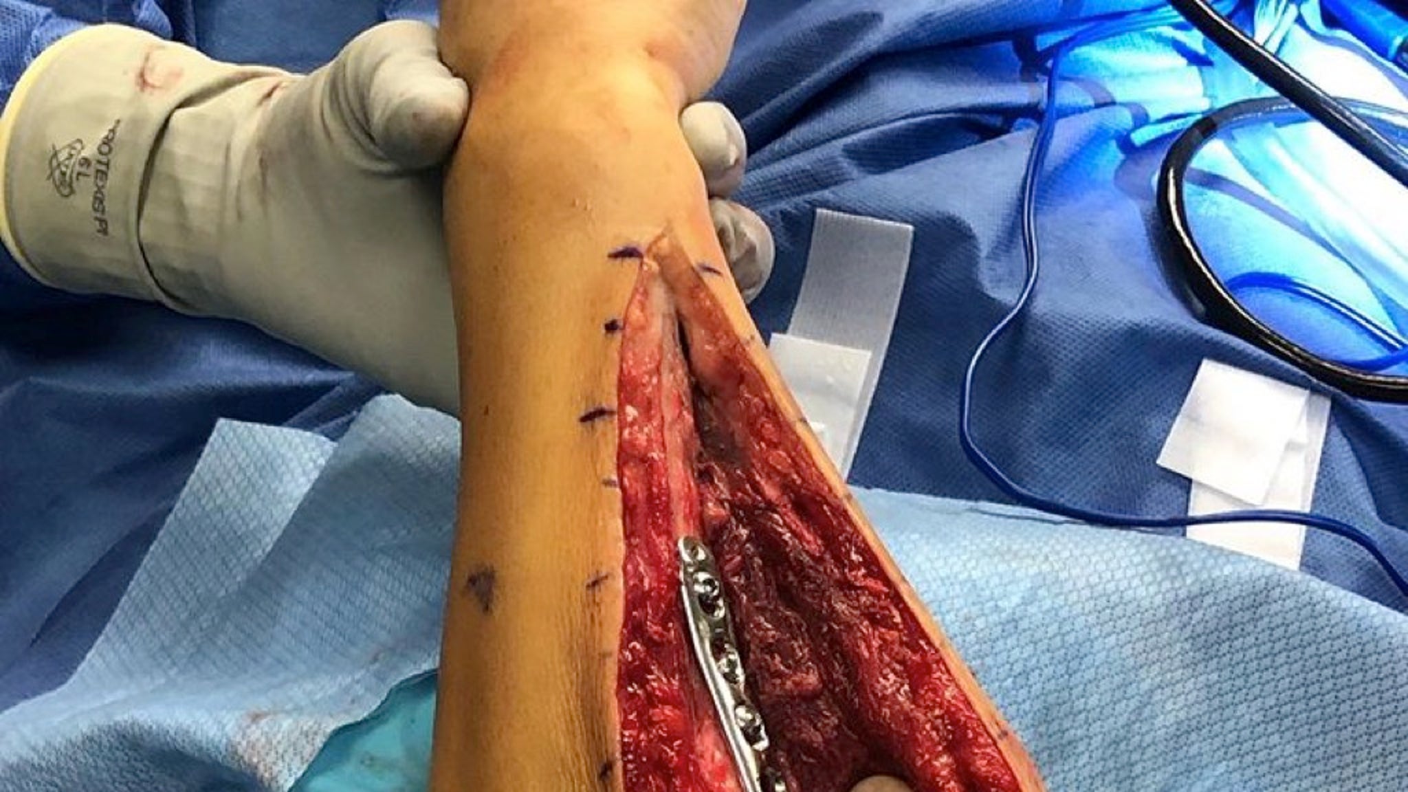 Paige VanZant's Gruesome Arm Surgery Photos