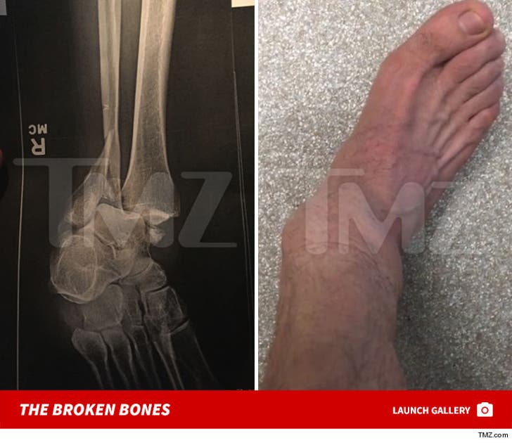 Steve-O's Foot Injury Photos
