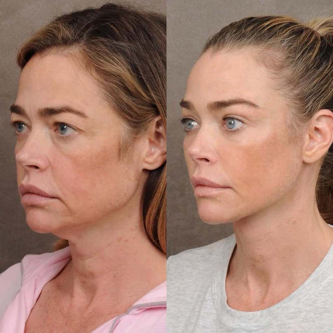 denise richards facelift 7