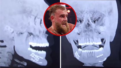 012026_jake_paul_xray_kal