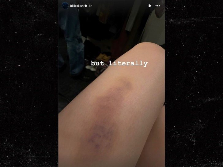 Billie Eilish com hematoma na perna