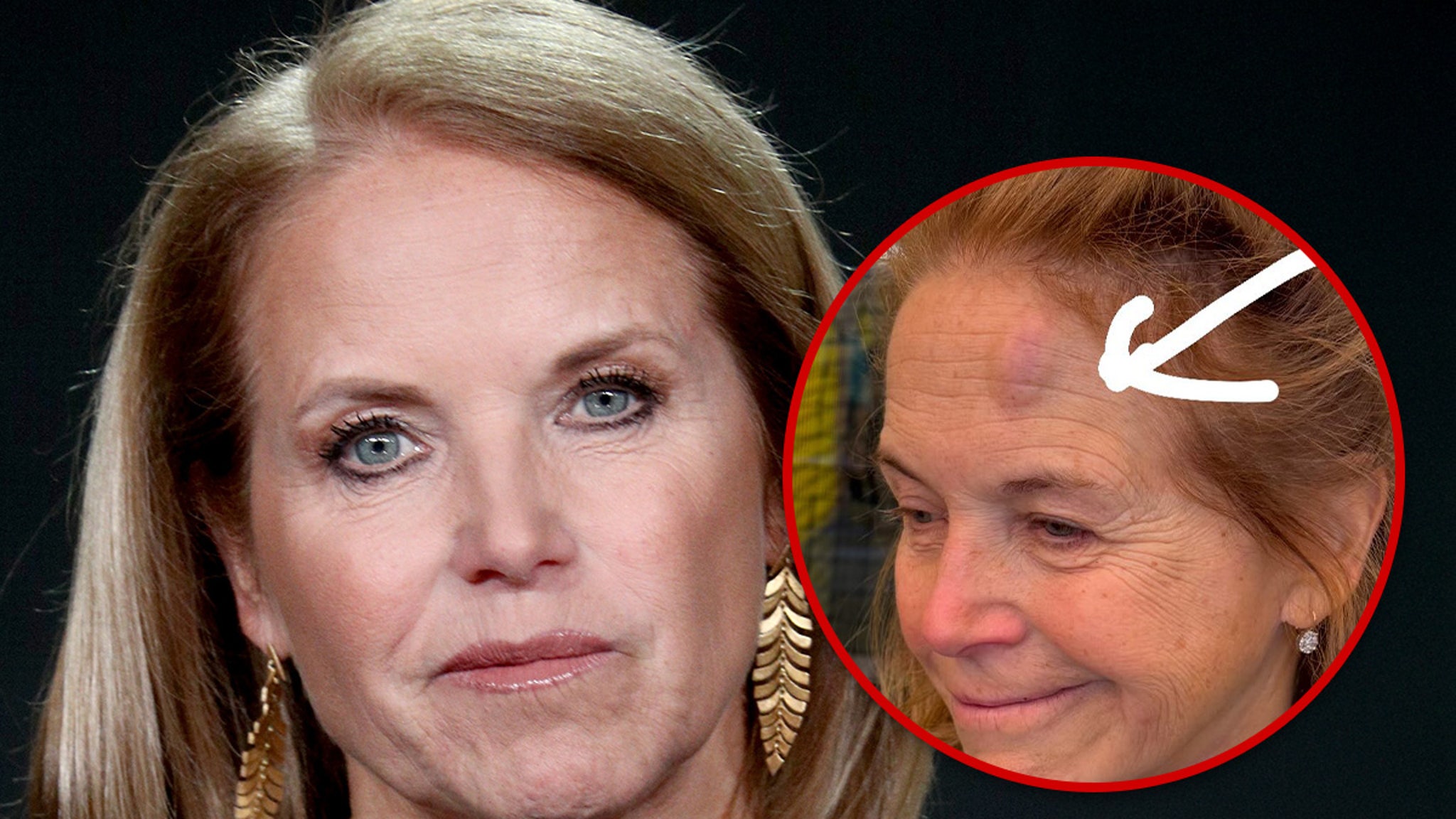 Katie Couric Debuts Nasty Forehead Bruise After Pickleball Accident