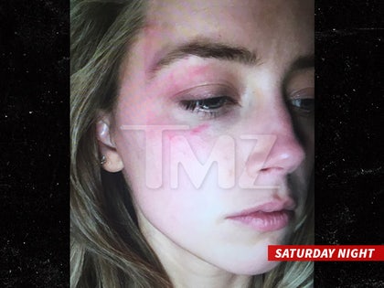 0527-amber-heard-injury-tmz