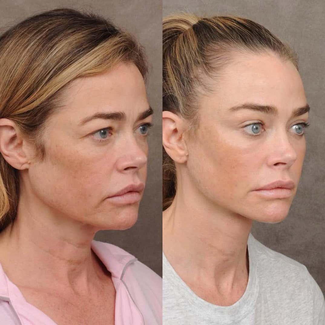 denise richards facelift 3