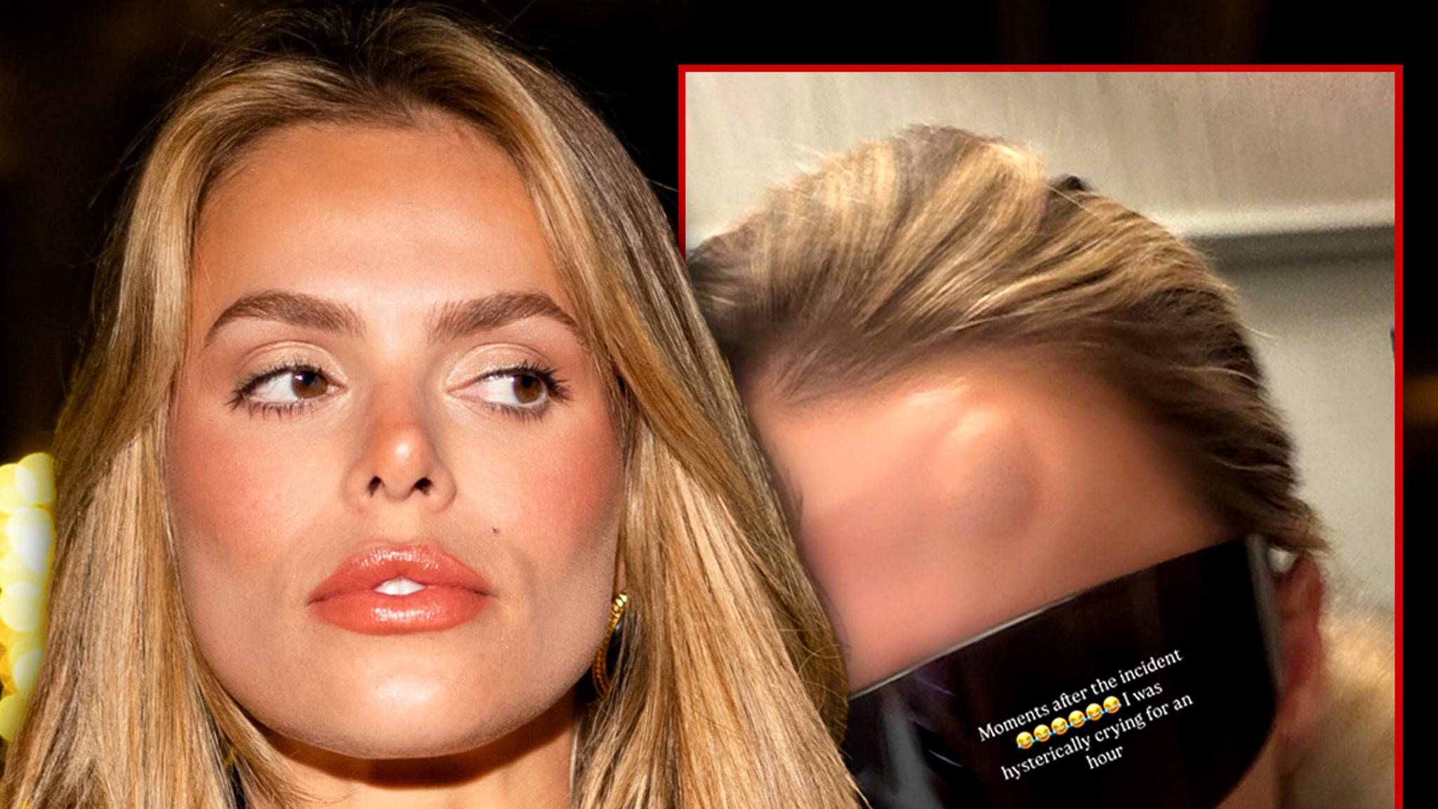 Brooks Nader Shows Off Big Bump on Her Forehead After Walking Into Door