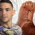 UFC Star Dustin Poirier Shows Off Foot Infection From Hospital