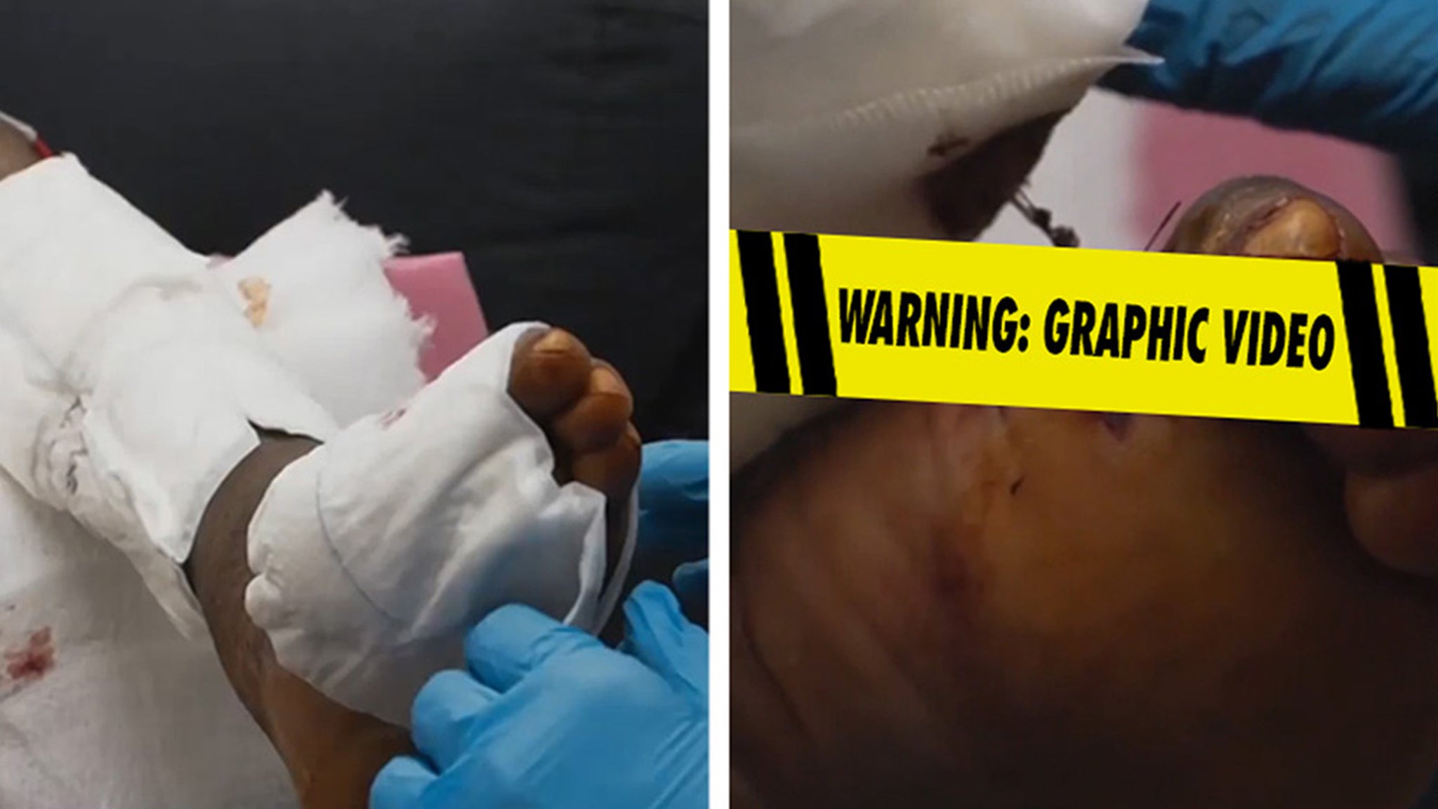 Deion Sanders의 발가락 절단이 새 비디오에서 공개되었습니다.