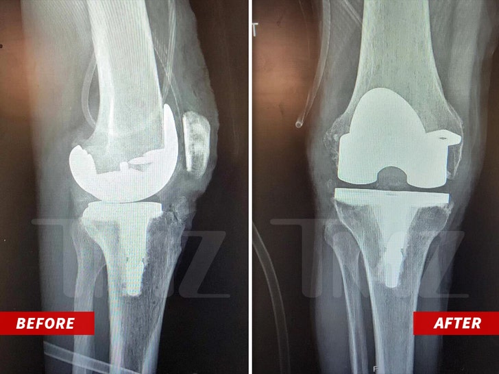 Caitlyn Jenner knee replacement
