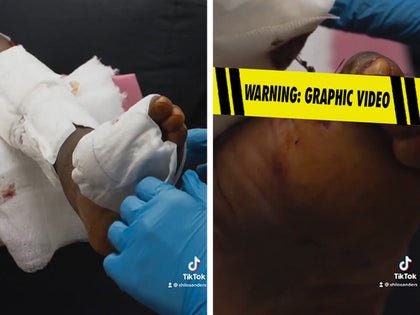 Deion Sanders' Amputated Toes Revealed In New Video