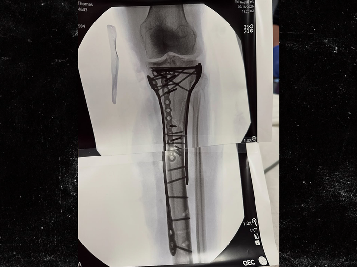 lindsey vonn surgery insta 1