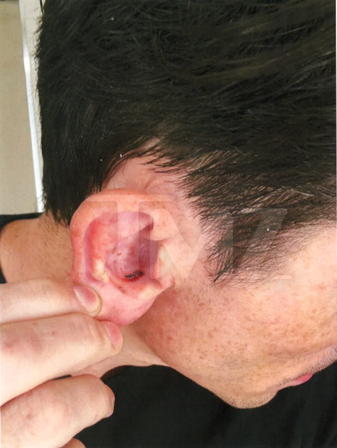 Tom Sandoval Injuries 1