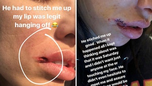 Johnny Manziel Fiancee's Lip 'Hanging Off' After Dog Fight