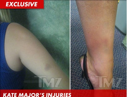 1025_kate_major_bruised_pictures_launch_EX_v2