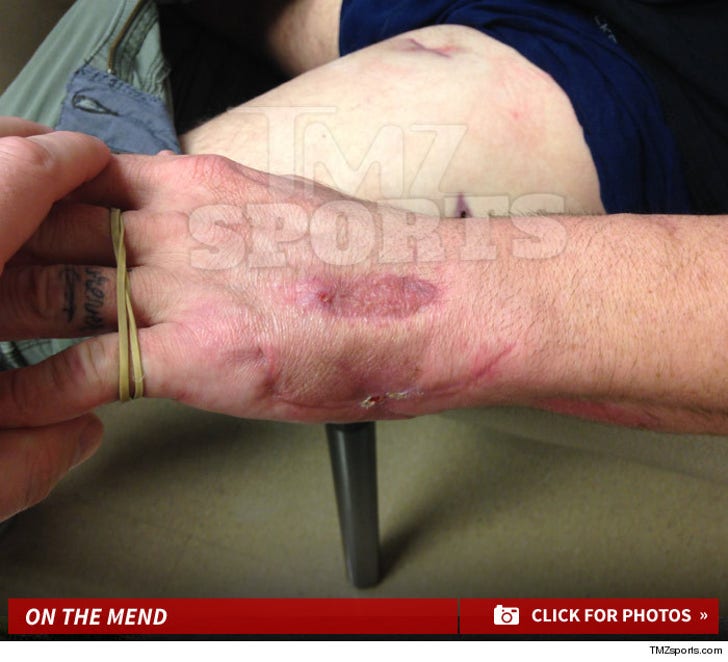 Joe Riggs' Gun Wounds -- On The Mend!