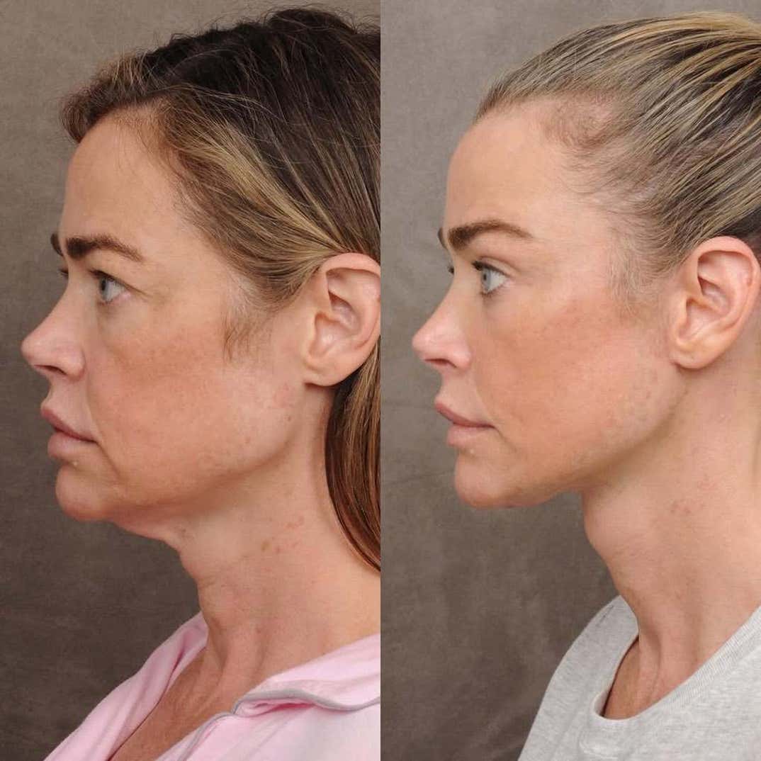 denise richards facelift 2