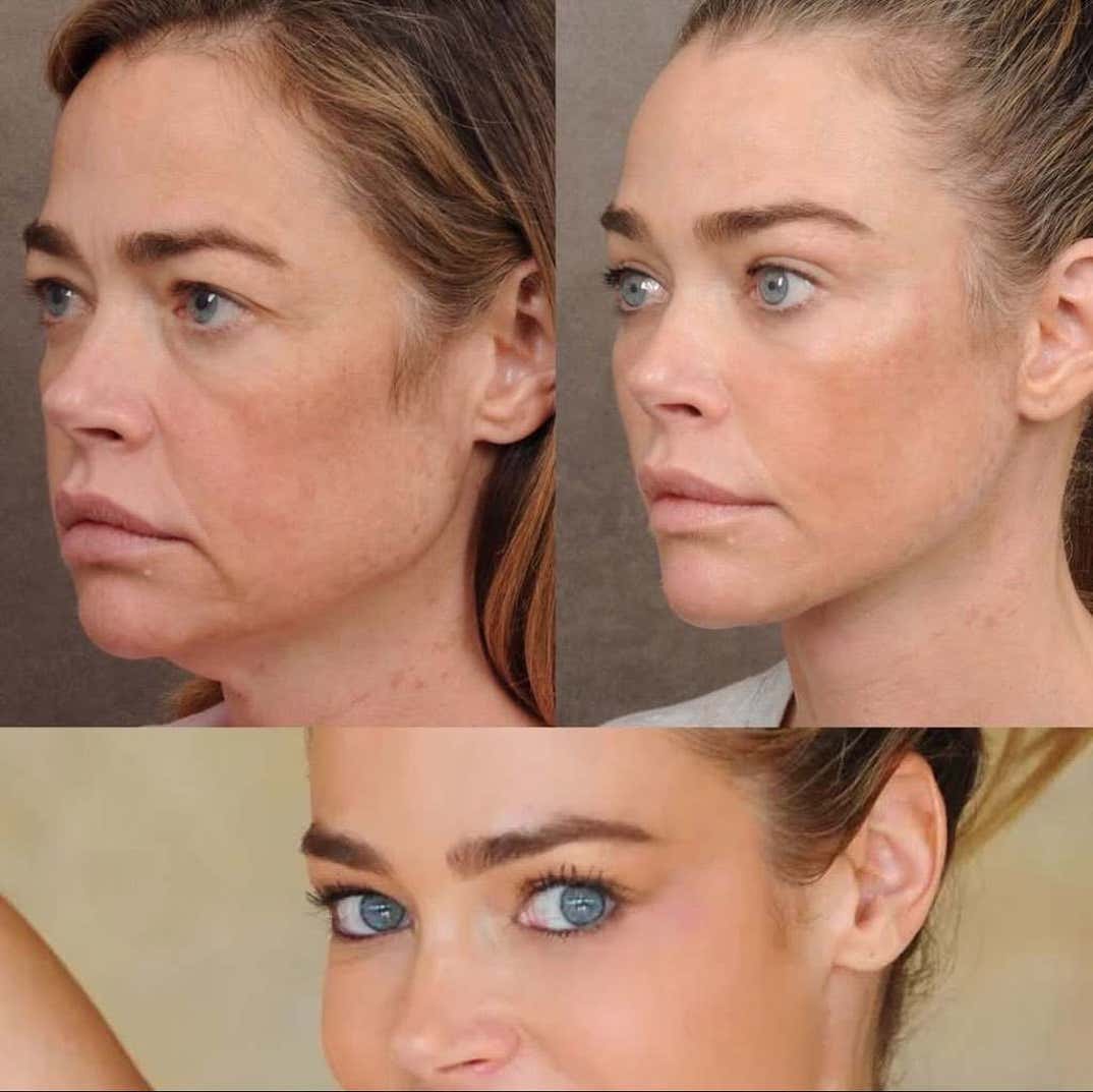 denise richards facelift 8
