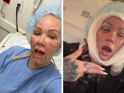 031626 bunnie xo facelift primary