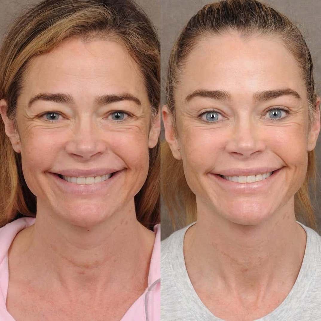 denise richards facelift 4