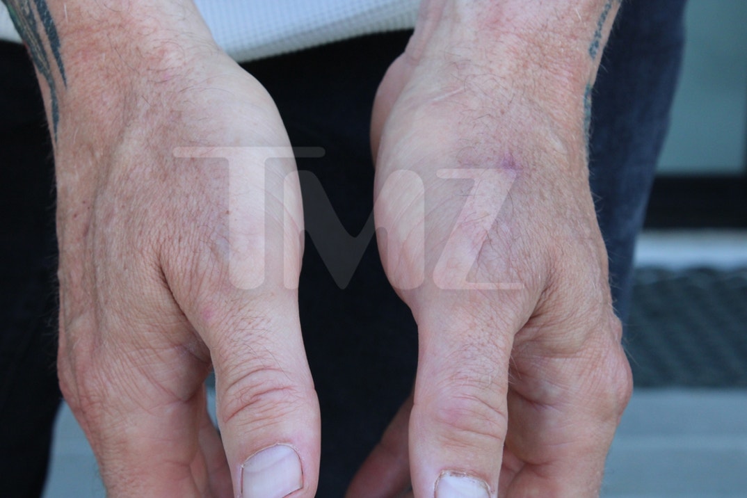 Alan Ritchson Injury Photos 3