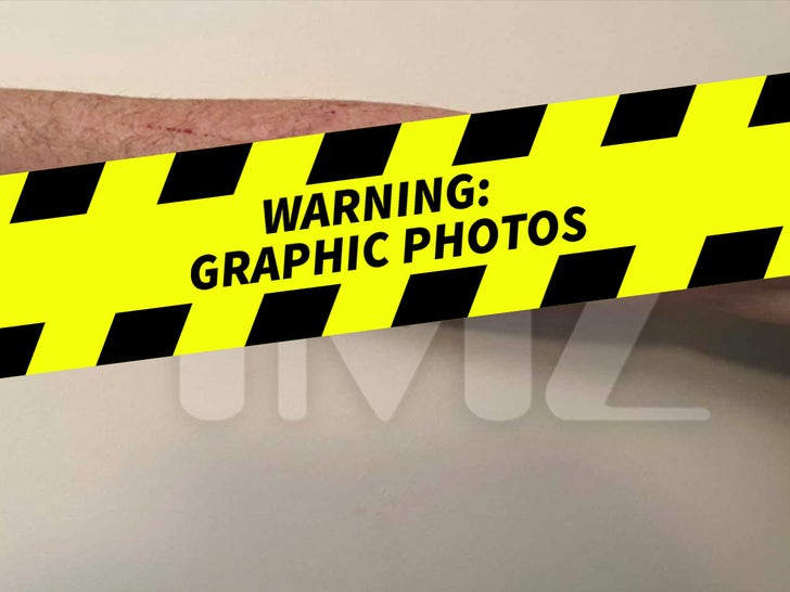 Sunbeam Sunburns -- See The Burns