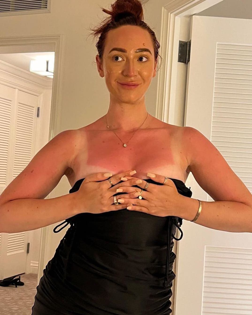 Celebrity Sunburns -- Guess Who!