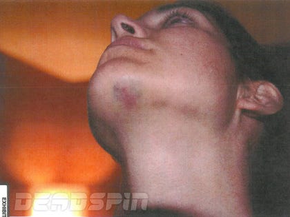 1106-greg-hardy-girlfriend-injuries-DEADSPIN-01