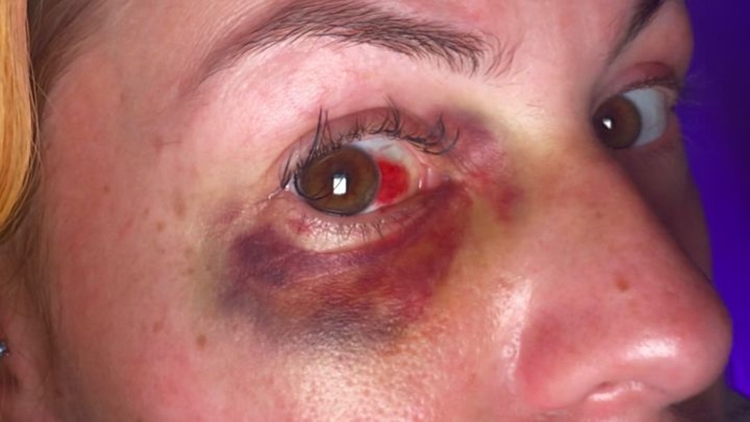 Pam Rodriguez Alleged Injury Photos 0