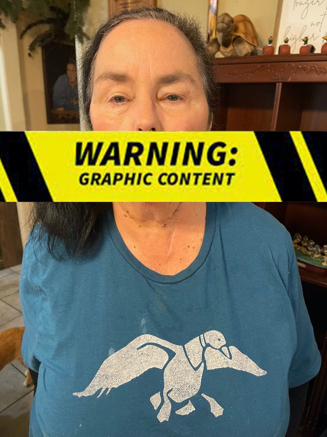 Kay Robertson Dog Bite Injury Photos