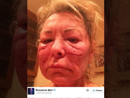 1126_roseanne_beaten_face_twitter