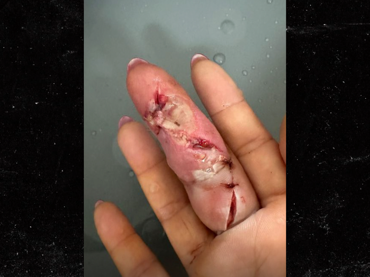 cj perry finger infected main