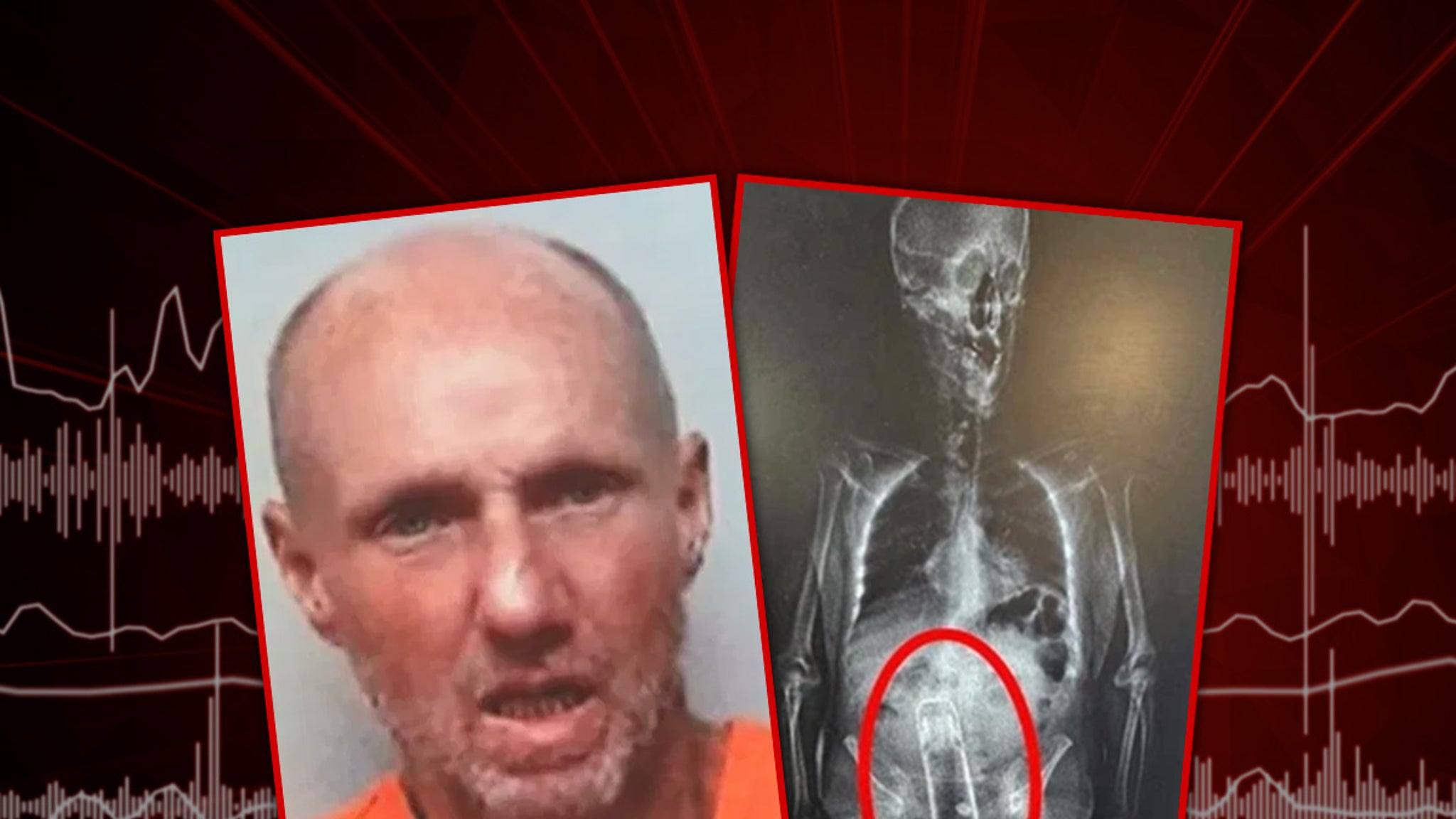 O cara da Flórida pegou o ânus com uma garrafa térmica, prendeu o show de raios X