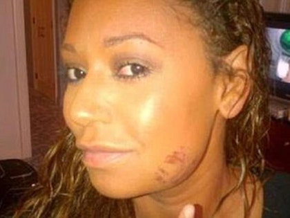 0403-mel-b-alleged-injuries-launch-PRIMARY-03