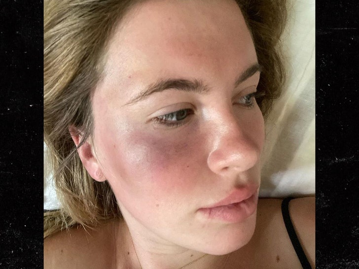 Ireland Baldwin Attacked by Crazed Woman on Drugs, Pics of Bruised Face