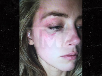 0606-amber-heard-injury-tmz-02