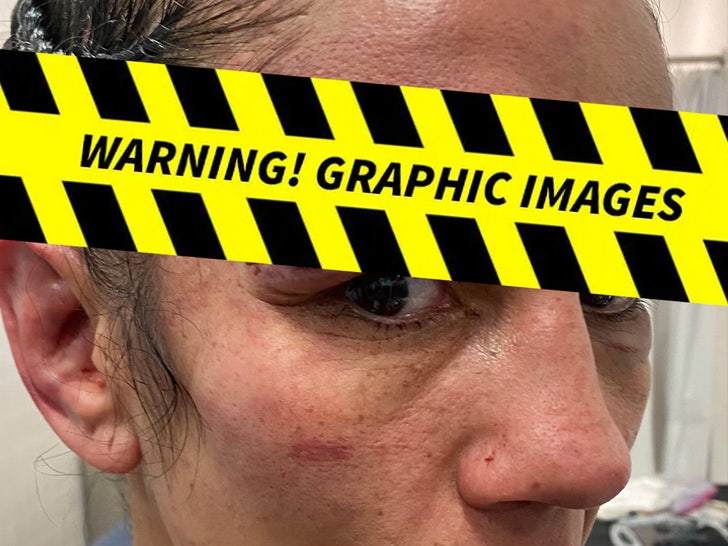 Amanda Serrano's eye injury