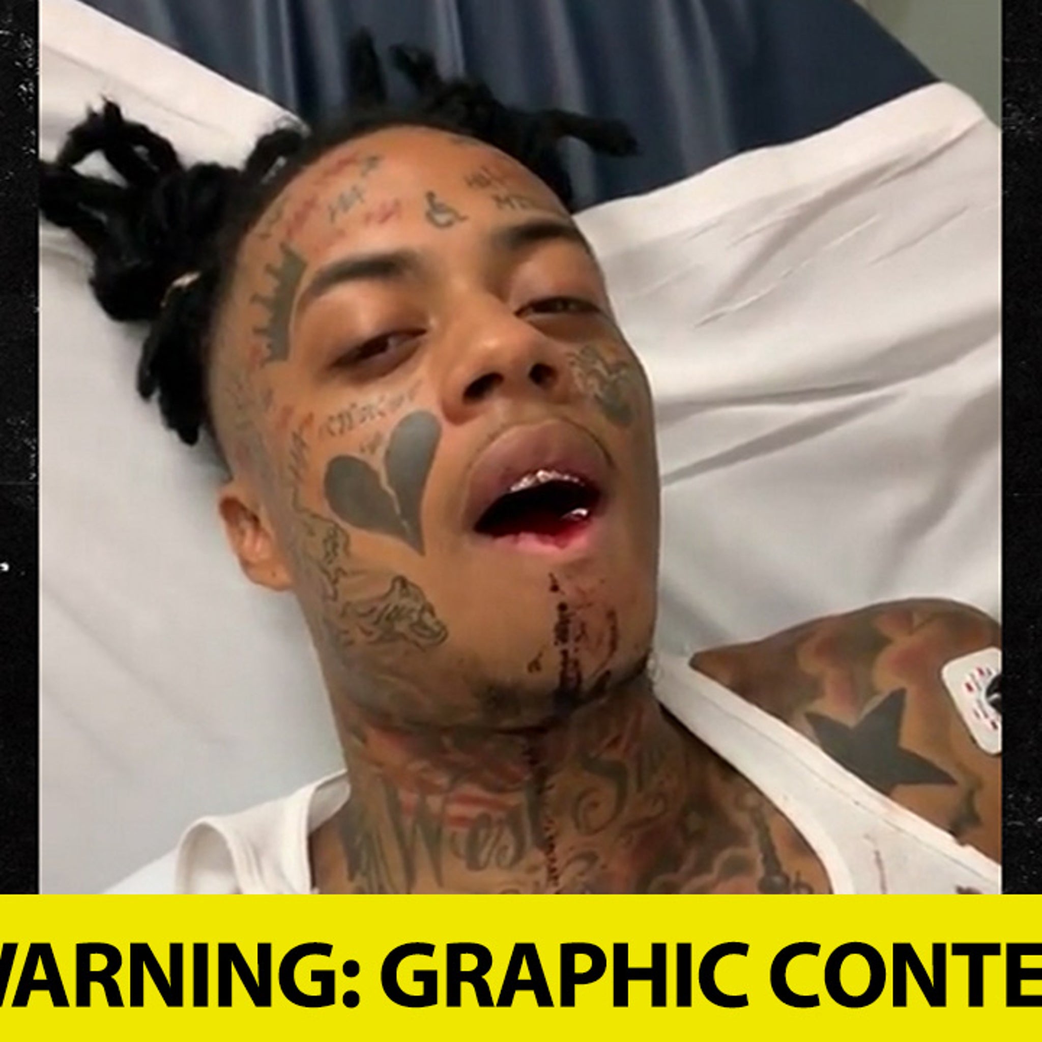 Rapper Boonk Recovers from Broken Jaw Surgery After Getting Punched