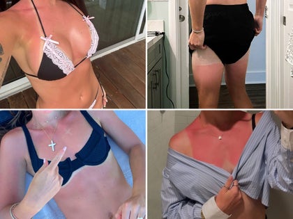0825-Celebrity-Sunburns-Guess-Who-PRIMARY